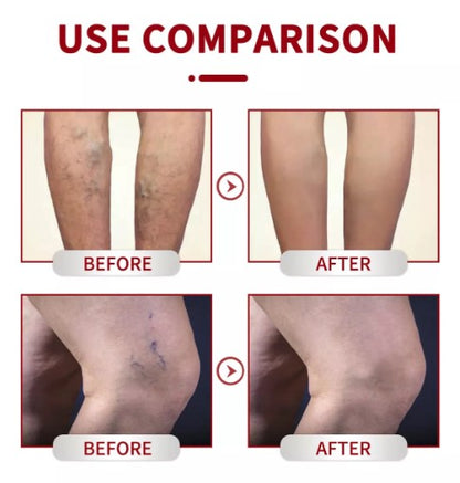 Varicose Veins Crema Para Varices 20gr x 2 Unidades